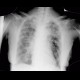 Lung carcinoma, carcinomatous lymphagiopathy, second radiograph: X-ray - Plain radiograph